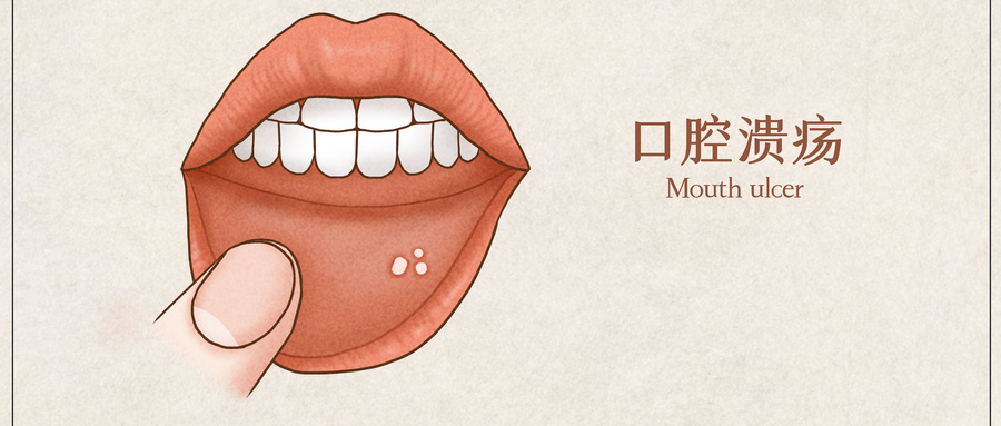 口腔溃疡怎么办最快最有效的方法？口腔溃疡经常反复是怎么回事